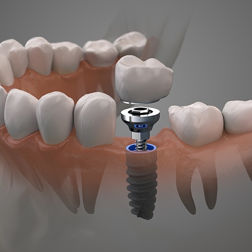 Osseointegration is a must for dental implant success