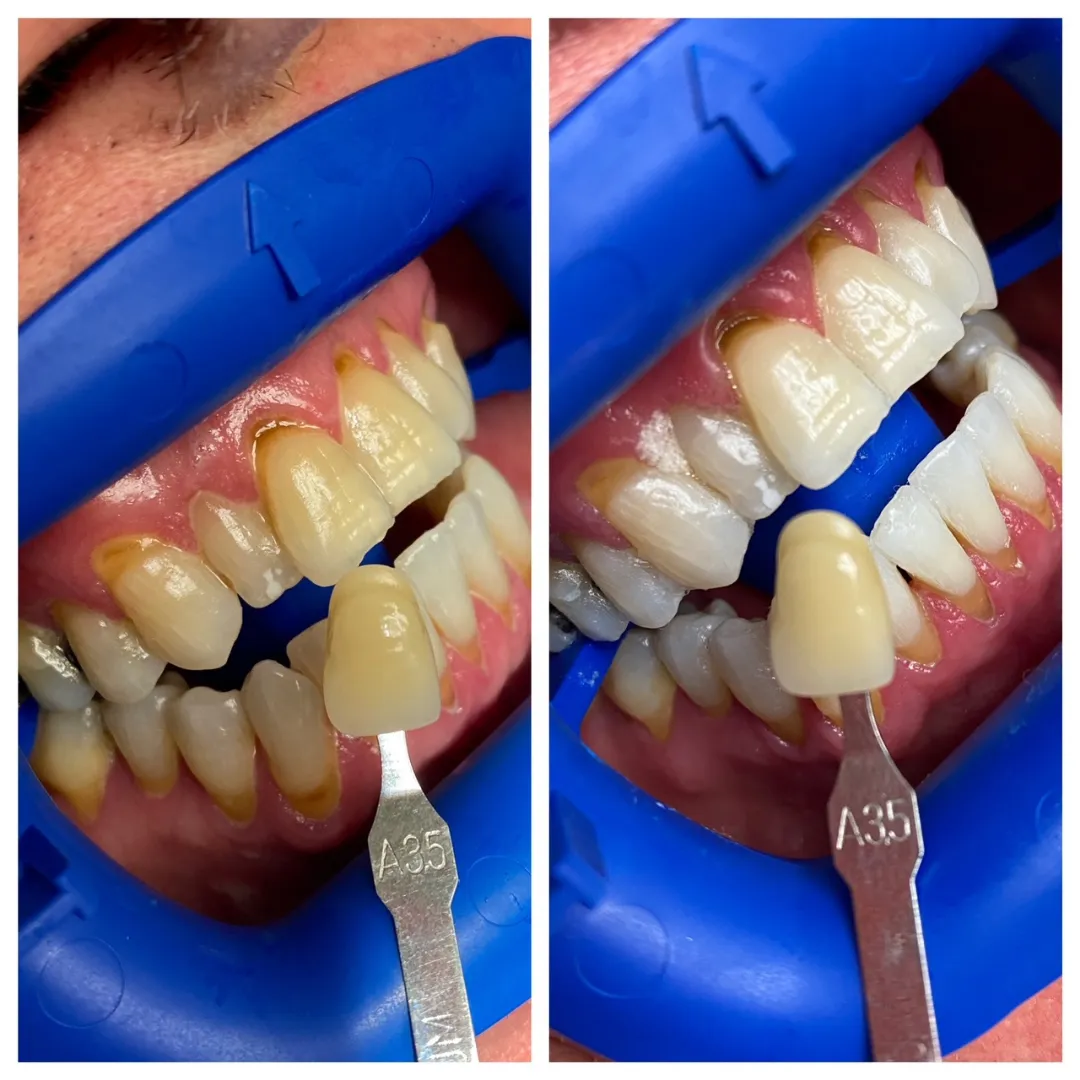 Dentist holding shade guide to a patients teeth before and after cosmetic dentistry
