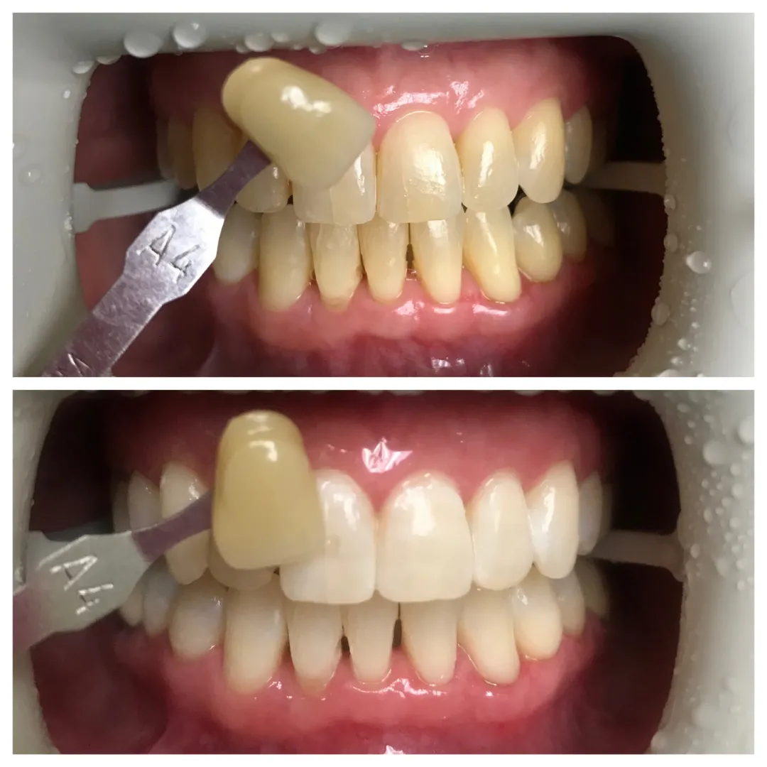 Dentist holding shade guide to a patients teeth before and after cosmetic dental work