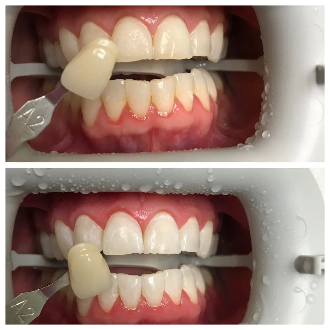 Dentist holding shade guide to a patients teeth before and after cosmetic dentistry treatment