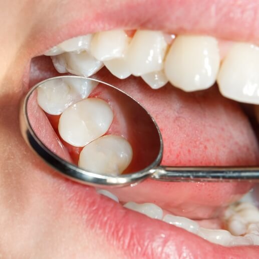 Close up of dental mirror in mouth reflecting tooth