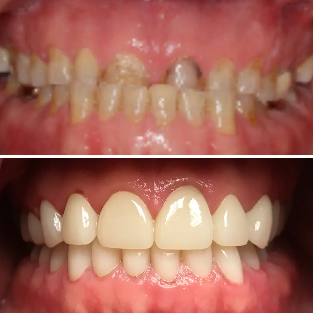 Close up of mouth before and after restoring damaged teeth with dental crowns