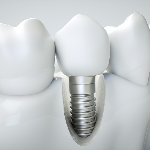 Illustration of dental implant in Frisco, TX in model of jawbone