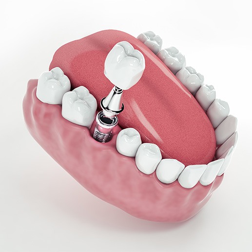 Dental implant, abutment, and crown being placed in lower jaw