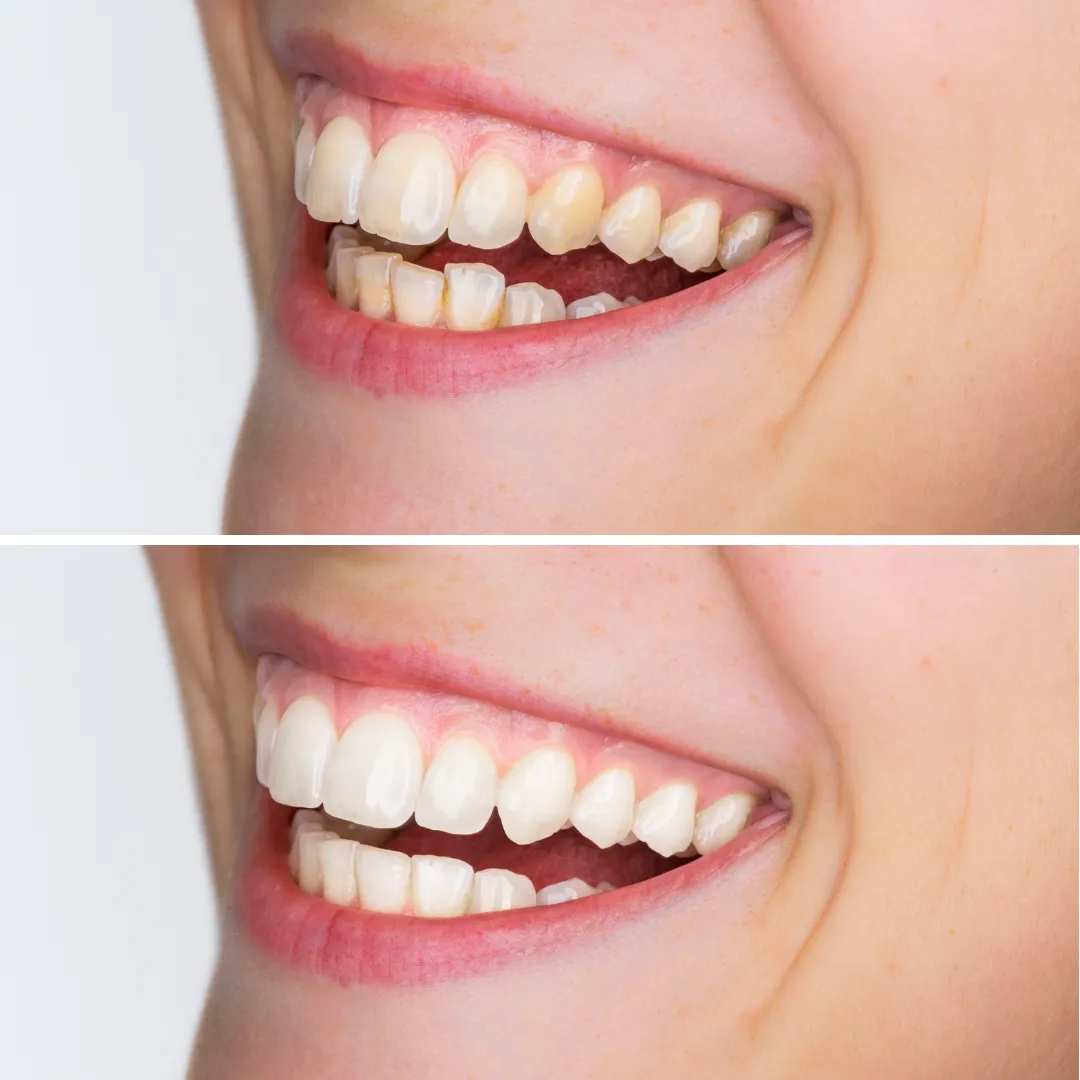 Close up of smile before and after fixing stained and damaged teeth