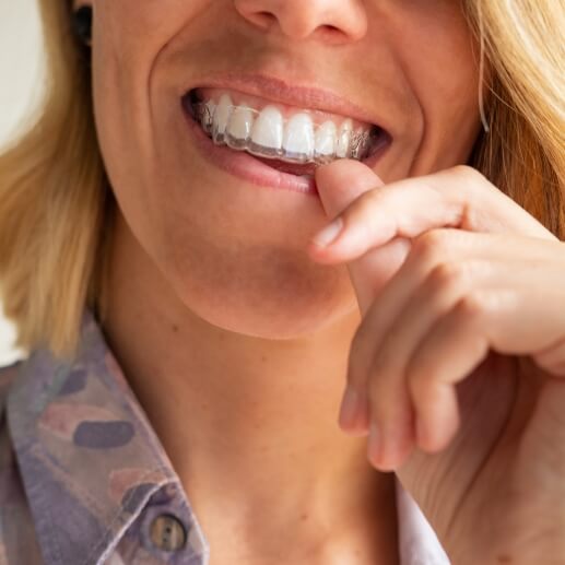 Close up of woman placing Invisalign tray over her teeth