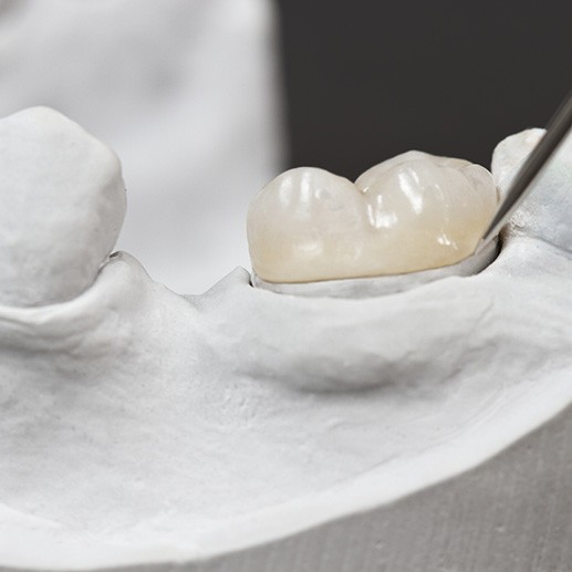 a dental crown on a plaster model of a mouth